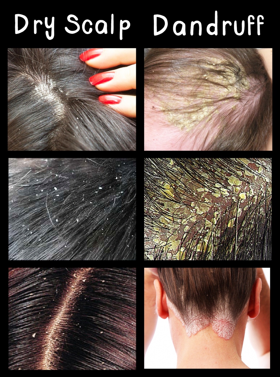 The Difference Between Dandruff And Dry Scalp